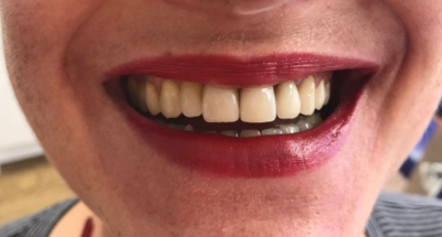 Vorher-Nachher-Bild | Bleaching, Füllung, Kieferorthopädie  | von ZA Julian Lang | Warmensteinach ea5d2f1c Nachher-Bild