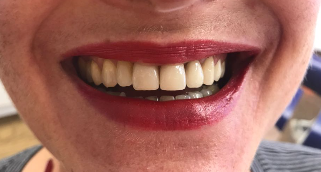 Behandlung Vorher-Nachher-Bild | Bleaching, Füllung  | von ZA Julian Lang | Warmensteinach fc490ca4 Vorher-Bild