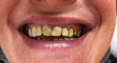 Vorher-Nachher-Bild | Bleaching, Füllung  | von ZA Julian Lang | Warmensteinach fc490ca4 Vorher-Bild