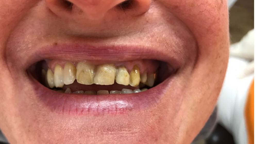 Behandlung Vorher-Nachher-Bild | Implantate, Invisalign  | von ZA Julian Lang | Warmensteinach fc490ca4 Nachher-Bild