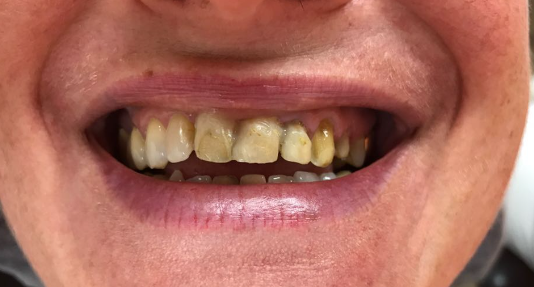 Behandlung Vorher-Nachher-Bild | Implantate, Invisalign  | von ZA Julian Lang | Warmensteinach fc490ca4 Vorher-Bild